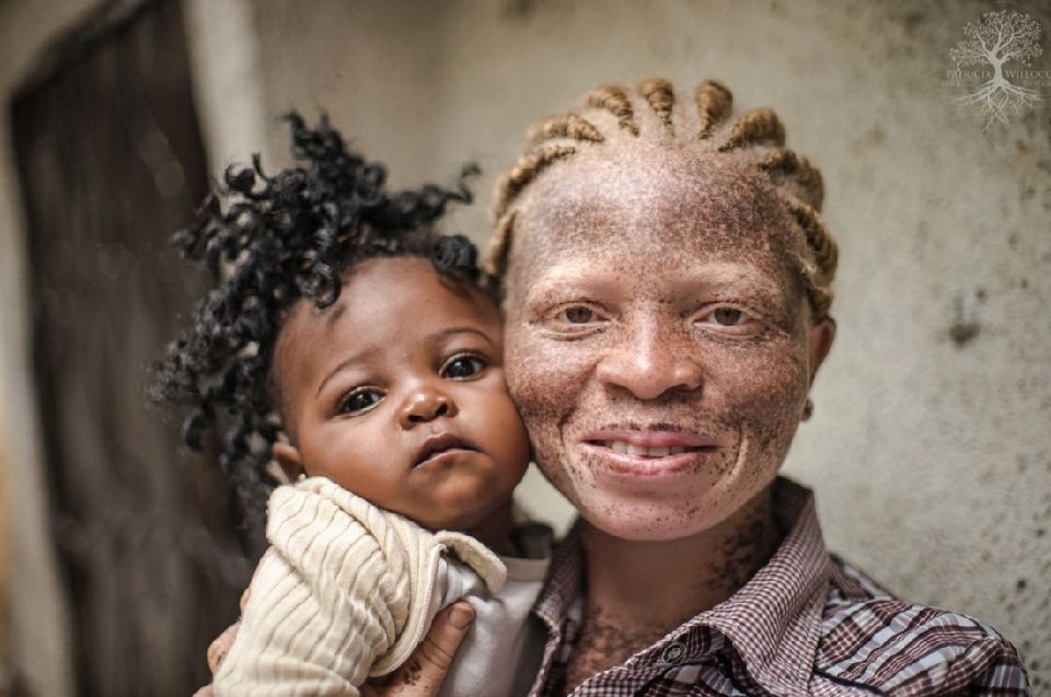 Mali: « Les enfants albinos sont interdits de jouer dehors pour ne pas être agressés pour leur prendre des cheveux, ongles ou gouttes de sang », Fatou Touré, « Maman Albinos »
