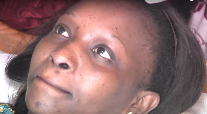 Santé : voici comment se débarasser des boutons sur le visage