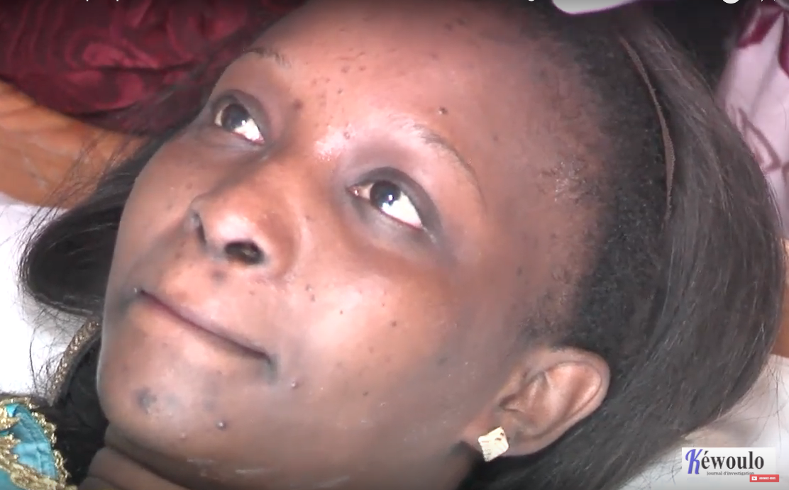Santé : voici comment se débarasser des boutons sur le visage