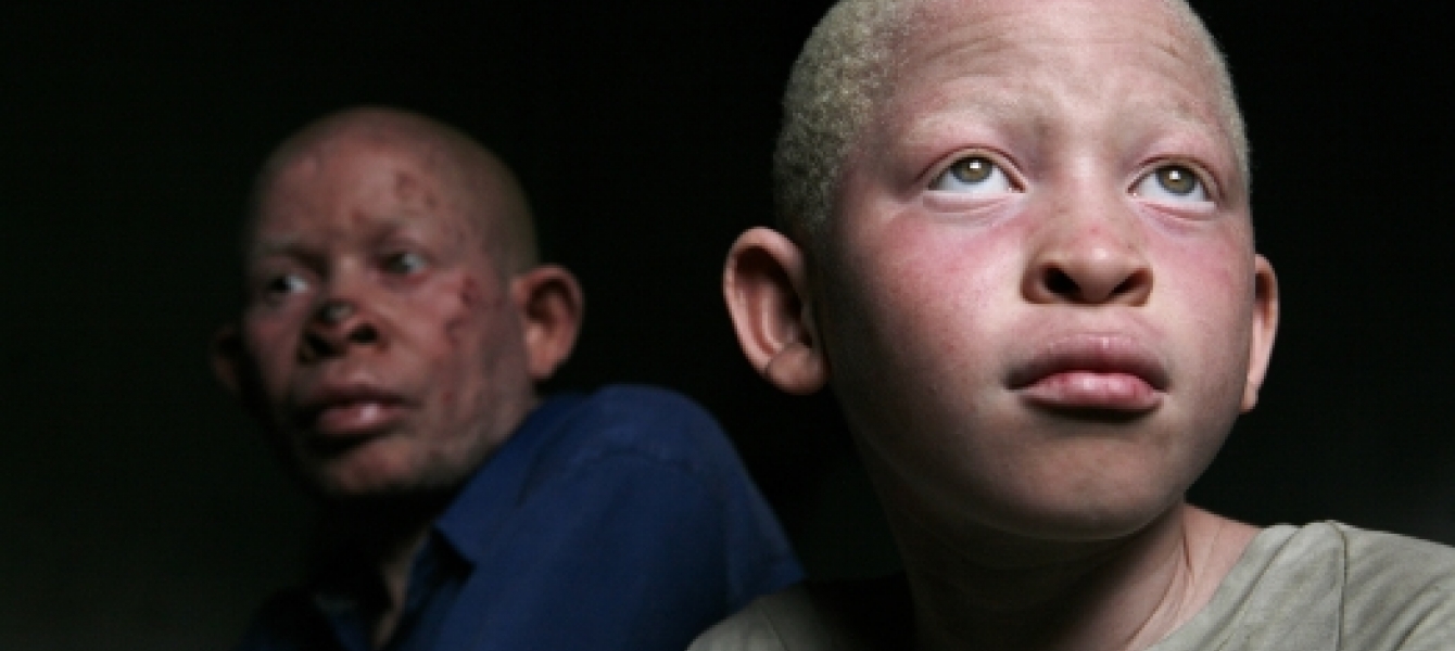 Société : Victime de stigmatisation ,les Albinos crient leur ras-le-bol