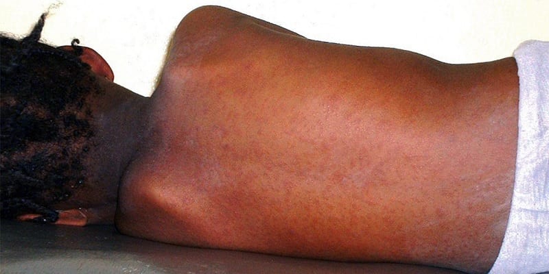 Bignona : Un cas de rougeole détecté au poste de santé de Badionkoto
