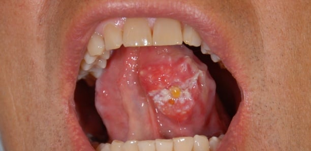 Cunnilingus, fellation…: ces pratiques sexuelles qui favorisent le cancer de la gorge