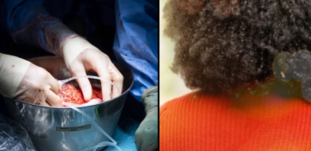 « Je me considère comme une survivante » : une patiente se confie après sa transplantation rénale