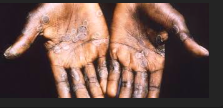 En Afrique, la résurgence de cas de Mpox inquiète puis signalée dans plusieurs pays comme…
