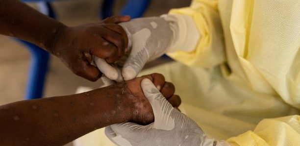 Guinée : premier cas du Variole du singe enregistré