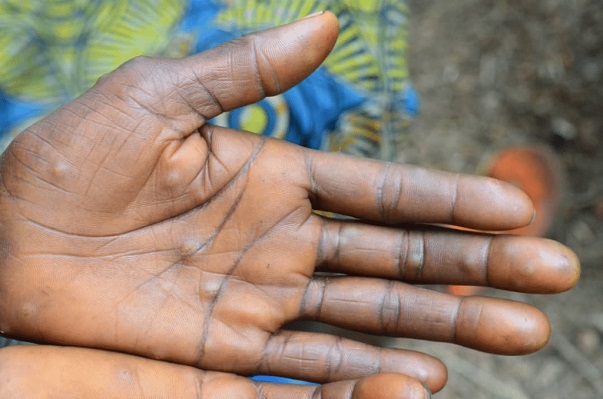 Mpox au Sénégal:  tous les cas suspects se révèlent négatifs (Dr Boly Diop)
