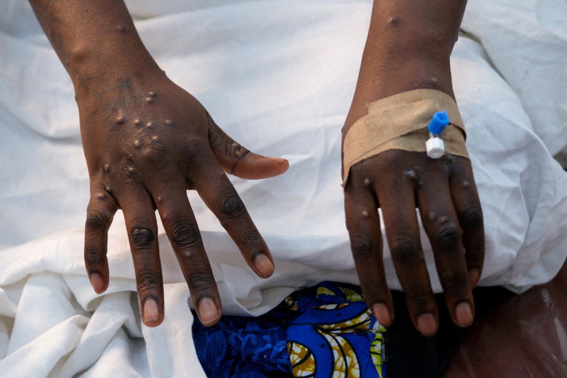 Santé : L&rsquo;OMS maintient son plus haut niveau d&rsquo;alerte sur le cas de mpox
