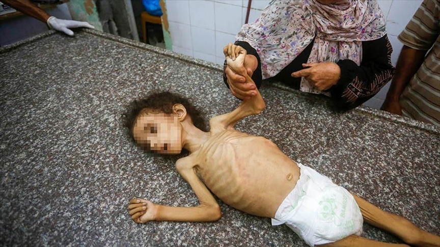 Gaza : Décès d&rsquo;une fillette de 4 ans des suites de malnutrition, selon l&rsquo;agence WAFA