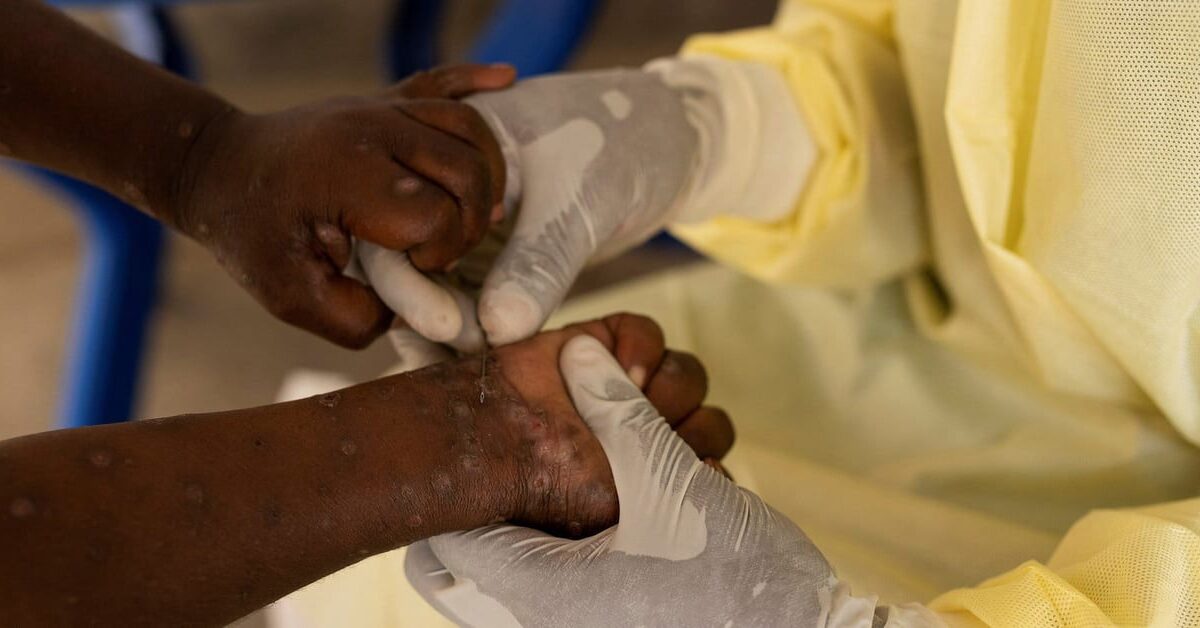 Variole du singe : Le Sénégal en alerte, un cas signalé en Gambie